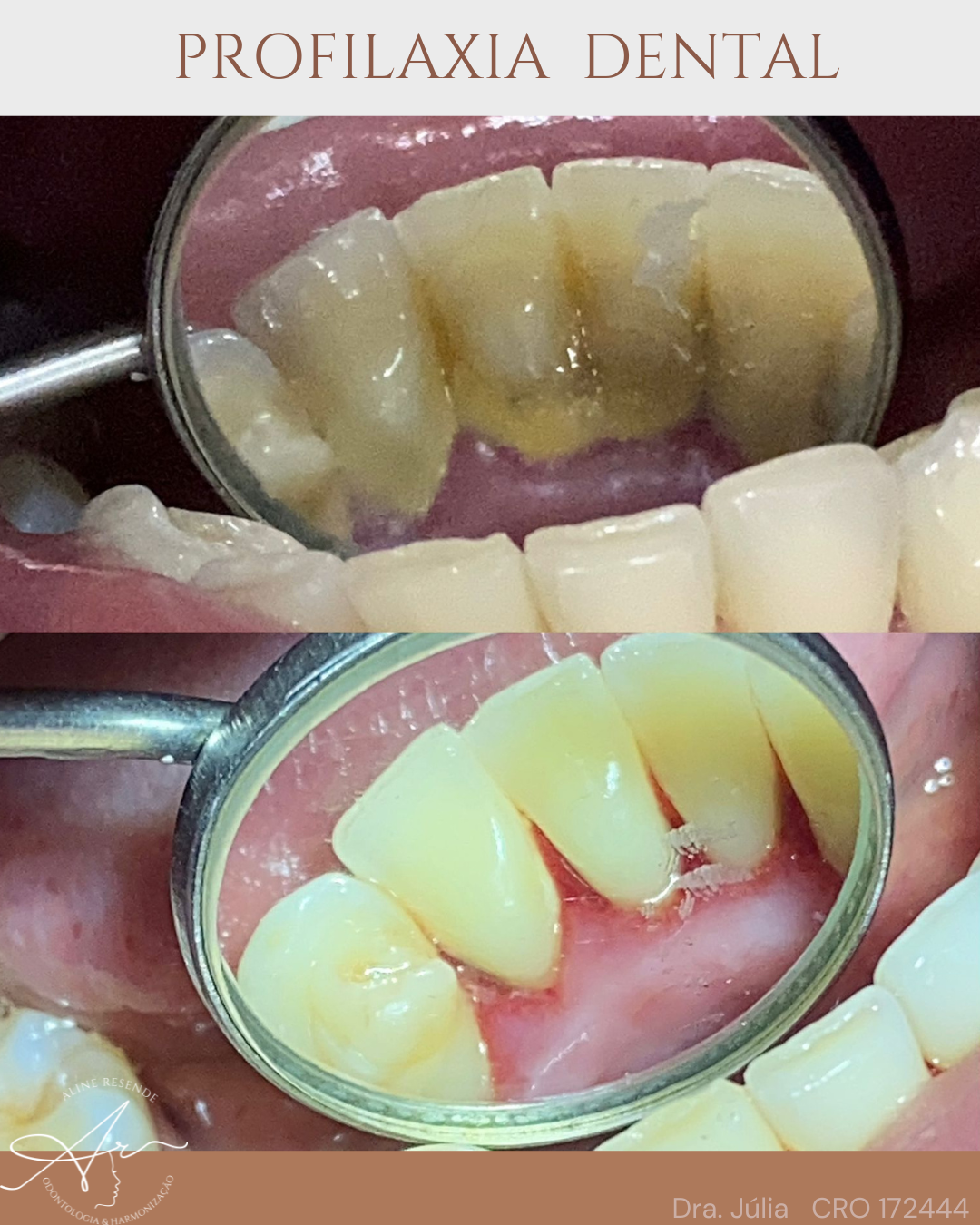 Profilaxia dental: o que é e com que frequência fazer