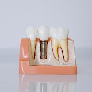 Modelo odontológico mostrando implante dentário instalado no osso.