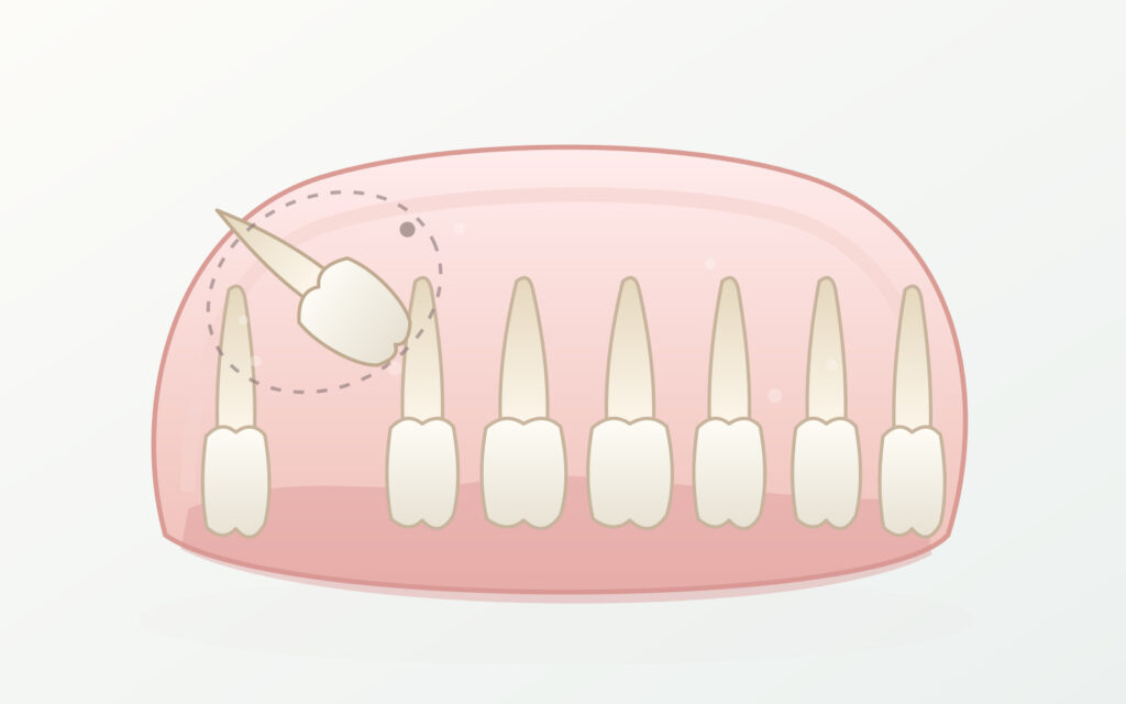 Ilustração esquemática de canino permanente incluso, posicionado acima dos dentes da arcada superior.